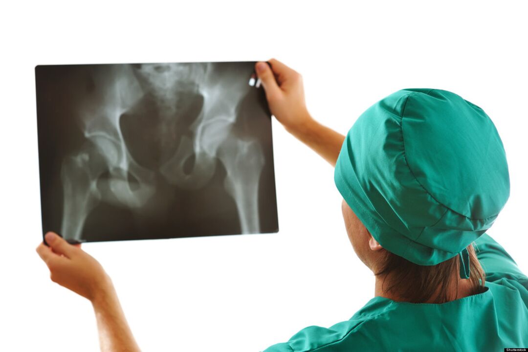 Röntgenbild eines Hüftgelenks mit Arthrose.